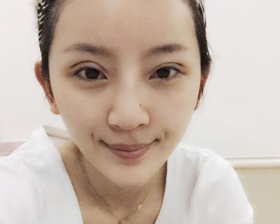北京悦丽格医疗美容诊所_周宜国_整形日记案例_自体