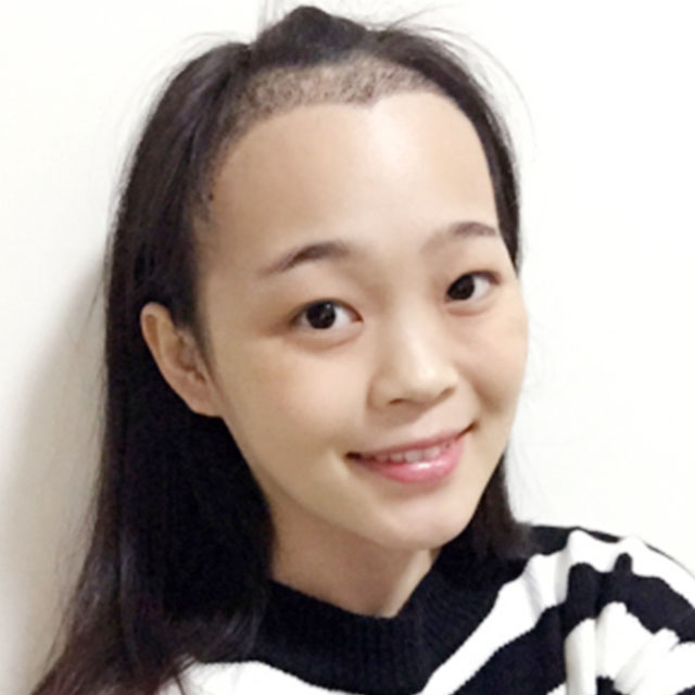 发际线种植